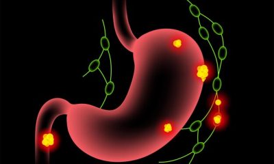 Top Nigerian Supplements for Ulcer Management