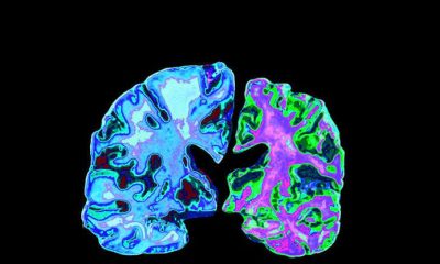 Early Signs of Alzheimer’s Disease in Seniors