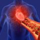 DASH Diet Meal Plan for Hypertension