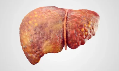 How to Reverse Fatty Liver with Lifestyle Changes