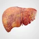 How to Reverse Fatty Liver with Lifestyle Changes