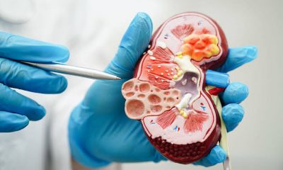 Early Symptoms of Kidney Failure in Adults