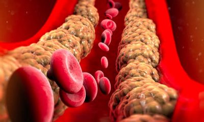 Natural Remedies to Manage High Cholesterol
