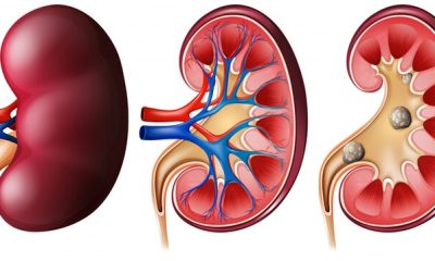 Cut These 5 Common Drinks to Reduce Your Risk of Kidney Damage