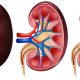 Cut These 5 Common Drinks to Reduce Your Risk of Kidney Damage