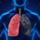 Signs of Early-Stage Lung Disease: Don’t Ignore These Warnings