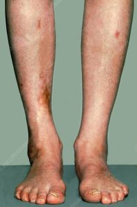 How to Detect Diabetes Without a Blood Test