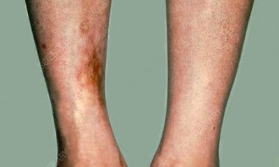 How to Detect Diabetes Without a Blood Test