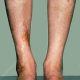How to Detect Diabetes Without a Blood Test