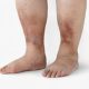 Signs of Diabetes in Feet and Legs
