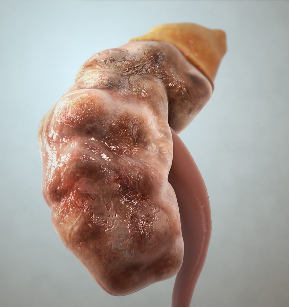 As Kidney Damage Rises Among Children, Experts Explain What Parents Must Know