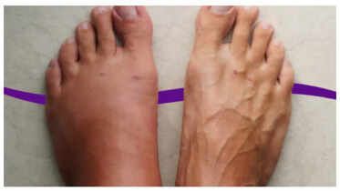 Early Warning Signs of Kidney Disease in Hands & Legs