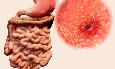 What to Eat When You Have Ulcer and Acid Reflux