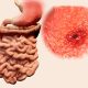What to Eat When You Have Ulcer and Acid Reflux