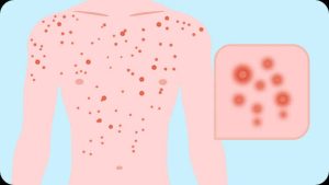 HIV Test Prices in Nigeria: Private and Public Hospital Comparison