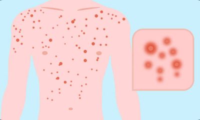 HIV Test Prices in Nigeria: Private and Public Hospital Comparison