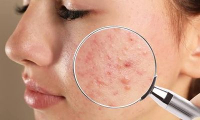 Best Acne Treatment Creams in Nigeria: Dermatologist Picks