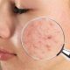 Best Acne Treatment Creams in Nigeria: Dermatologist Picks