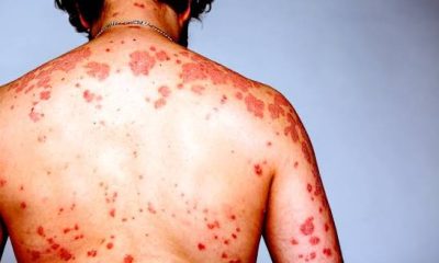 Early Signs of HIV in Women: What Nigerians Should Look Out For