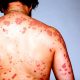 Early Signs of HIV in Women: What Nigerians Should Look Out For