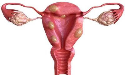 Fibroid Treatment in Nigeria: Hospitals, Costs, and Options