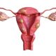 Fibroid Treatment in Nigeria: Hospitals, Costs, and Options